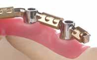 Portfolio Overview CARES screw-retained bars and bridges are prosthetic