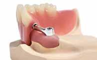 intended as an aid in prosthetic rehabilitations for multiple-tooth