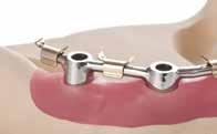 insertion axis of the attachments More resistant against mastication forces,
