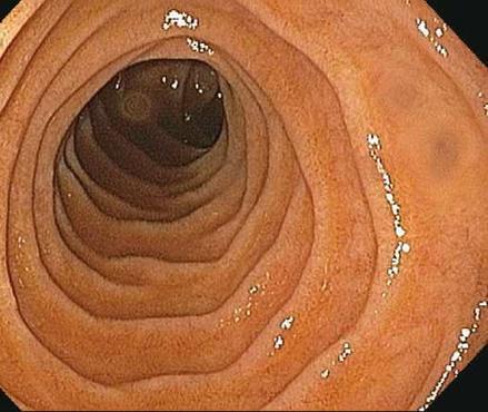 Examining the Duodenum Bulb:First portion of the duodenum Turn right