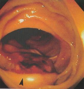 Aortoenteric Fistula BEWARE: The elderly patient with a suspected UGI