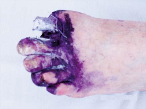 of 2nd 5th digits; all lesions were disinfected using gentian violet Figure 4.