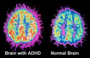 Causes of ADHD ADHD is caused by developmental differences in the brain that affect the areas controlling