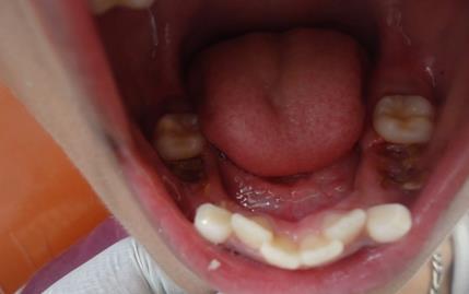 An 8 year- old boy reported to the Department of Paedodontics and Preventive Dentistry of Maharaja Ganga Singh Dental College and Research Centre with the chief complaint of difficulty in chewing