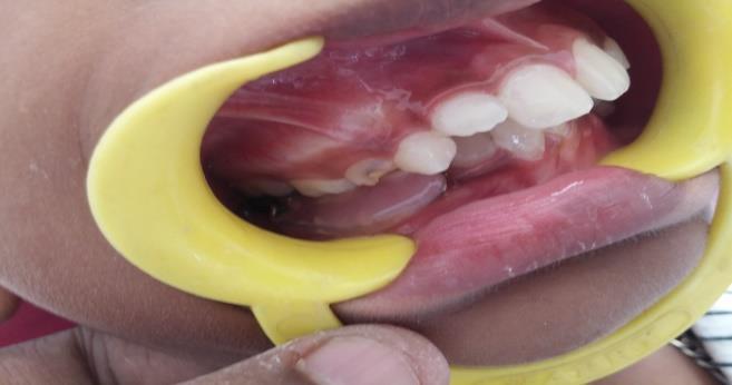 Figure 2: The fixed functional appliance with acrylic teeth for acrylization procedures.
