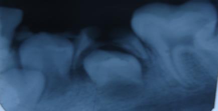 Figure 5: Pre operative Intra oral periapical radiograph of lower right side. Note the root formation of 44 and 45. space maintainer for him.