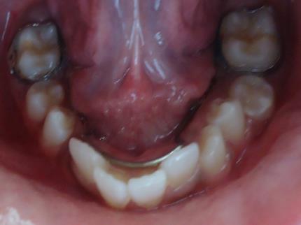 The present case reported to us with grossly decayed 74, 75 and 84, 85 which caused arch length deficiency along with moderate crowding in the anterior region.