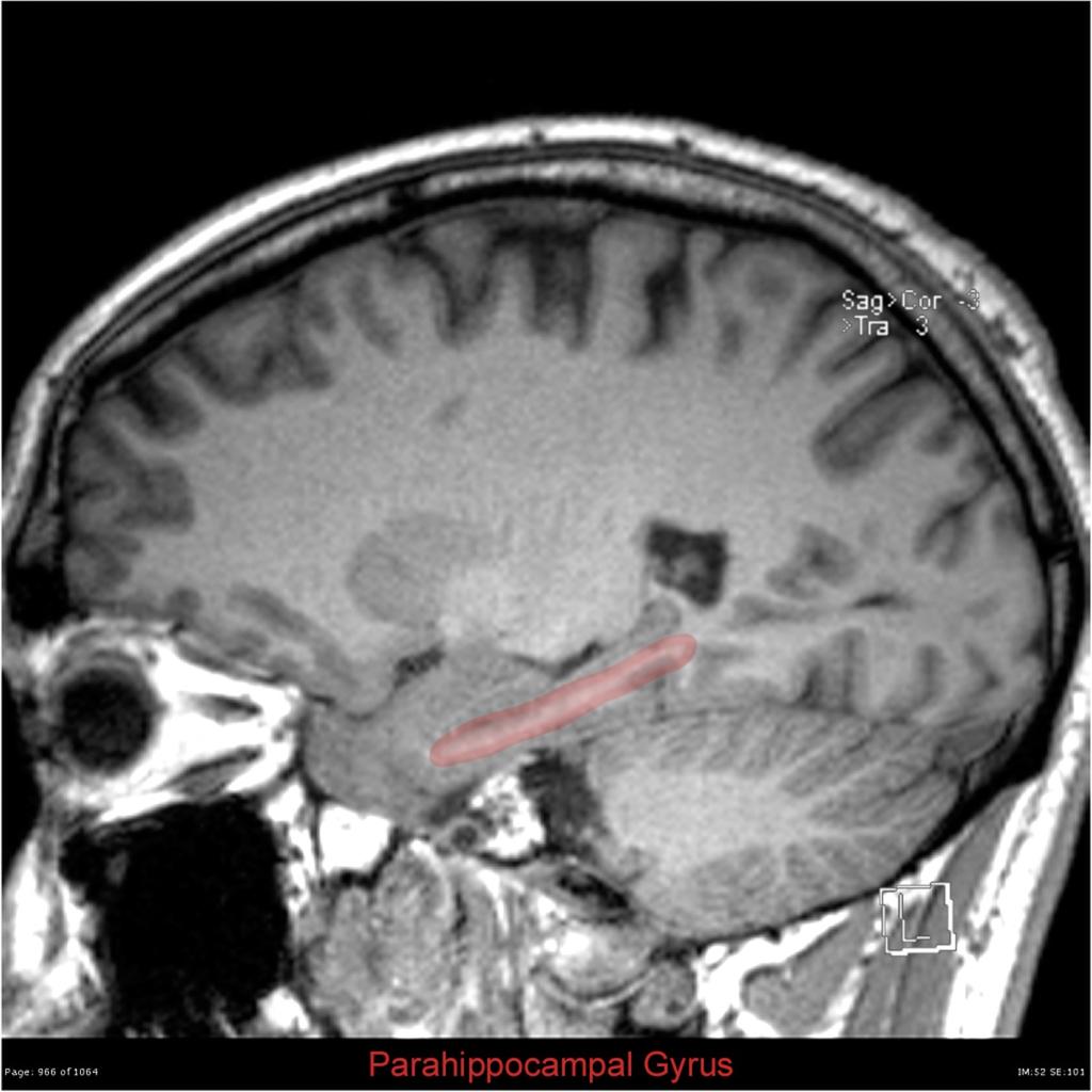 Fig. 8: Parahippocampal Gyrus Case courtesy of Dr