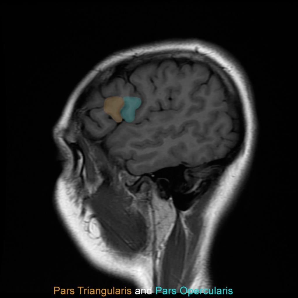Fig. 2: Pars Triangularis and Pars Opercularis Case courtesy