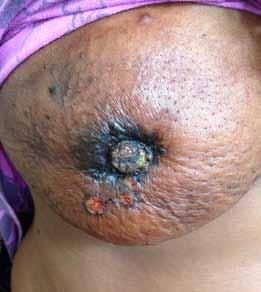 Carcinoma breast in males is different from that in females, as in males there is minimal fat tissue and direct infiltration into the chest wall occurs earlier.