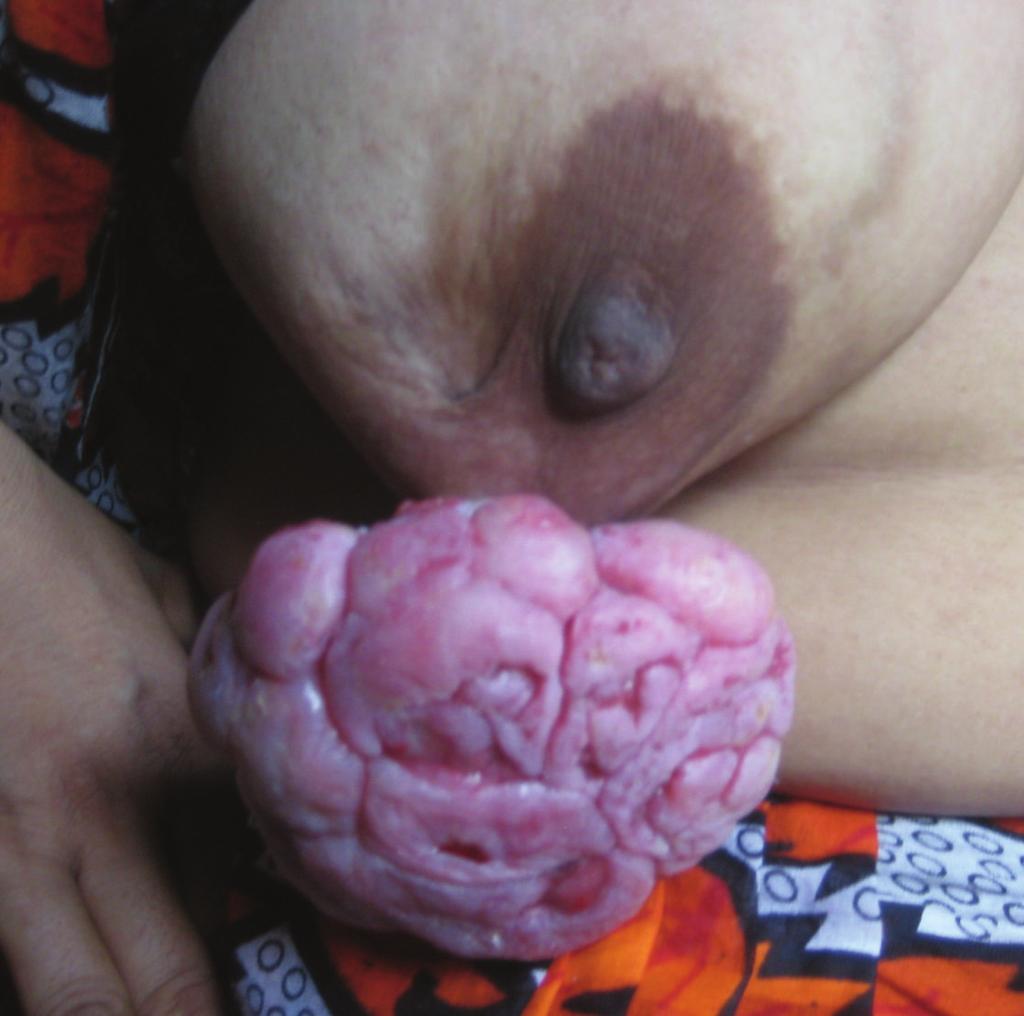 2 Figure 1: Ulcerated fungating mass, with irregular surface and nodular appearance, occupying the lower and outer quadrants of the right breast, at the time of presentation.