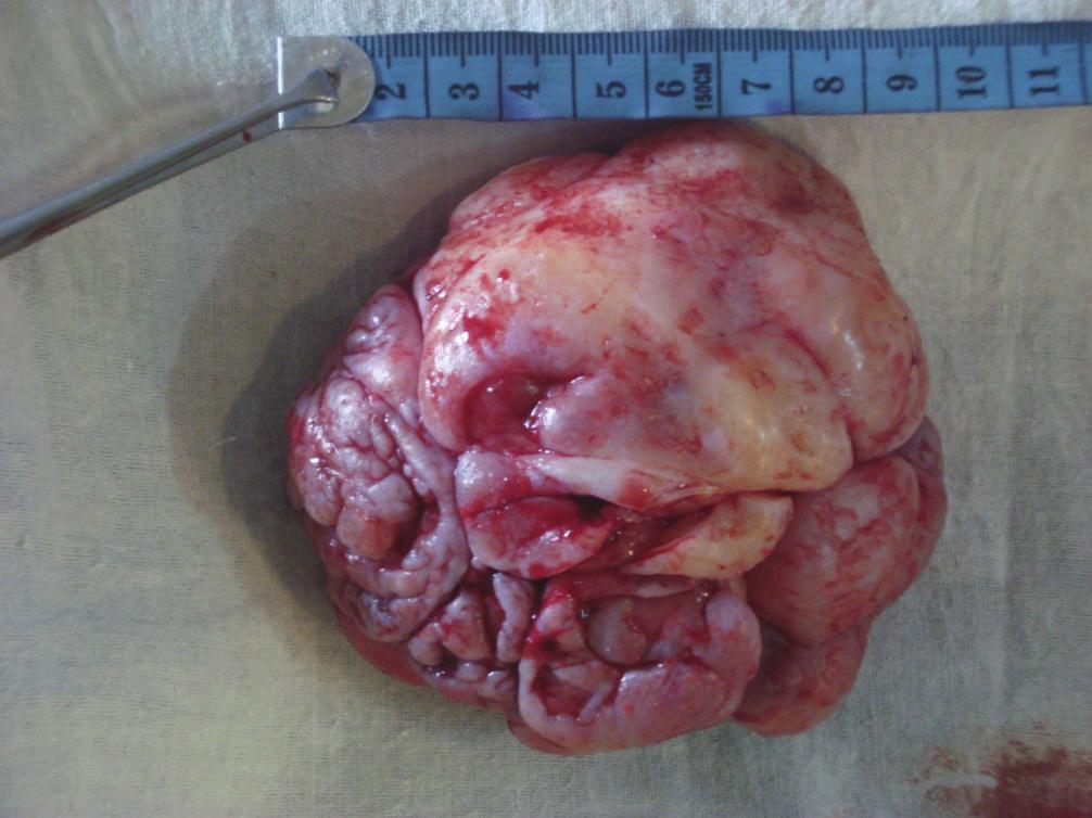 5 cm in size and the tumor was not invasive to the surrounding tissues. a year.