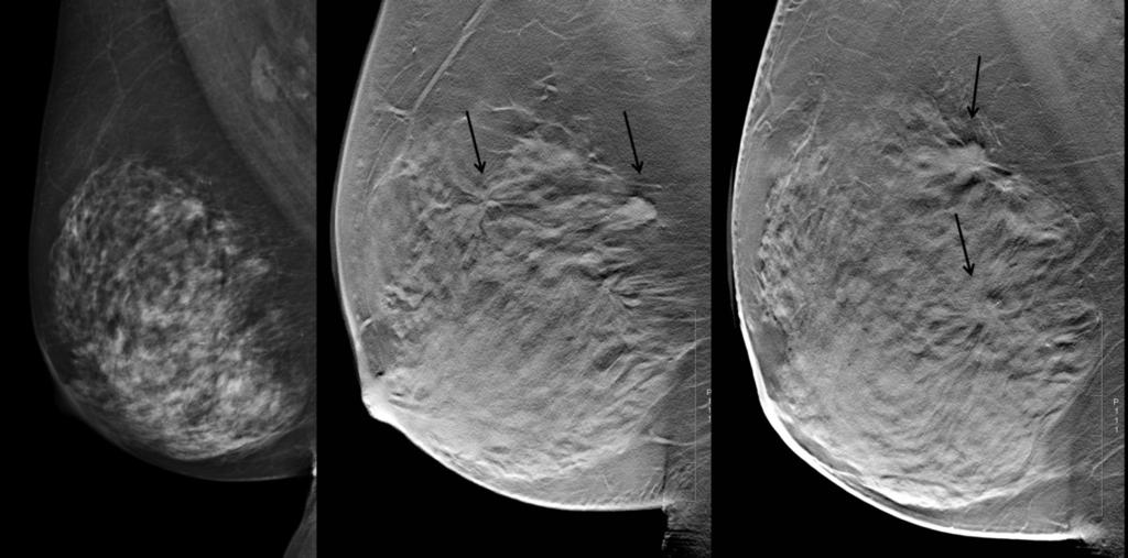 Fig. 0: Fig. 4. Palpable lesion in the right breast.
