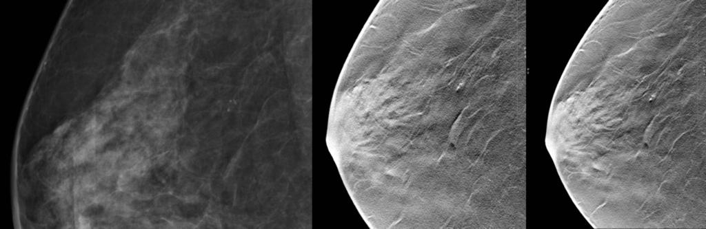 On the corresponding slice of the tomosynthesis set of images, only the most dens calcifications can be discerned, the fine low density calcifications were not seen on the different slices.