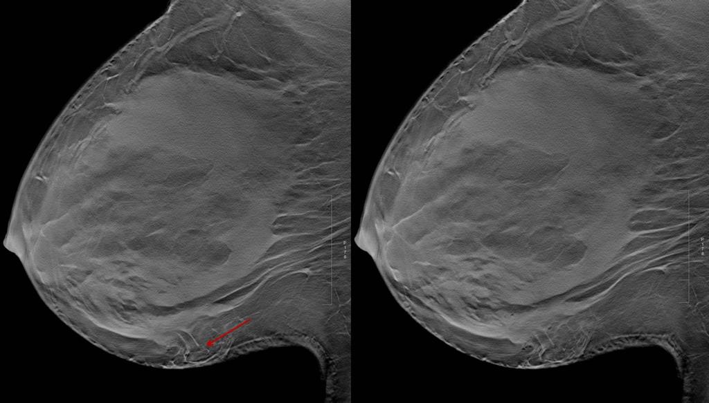 Fig. 0: Fig 7b. Corresponding slices of the tomosynthesis set of images of the right breast (fig 7a).