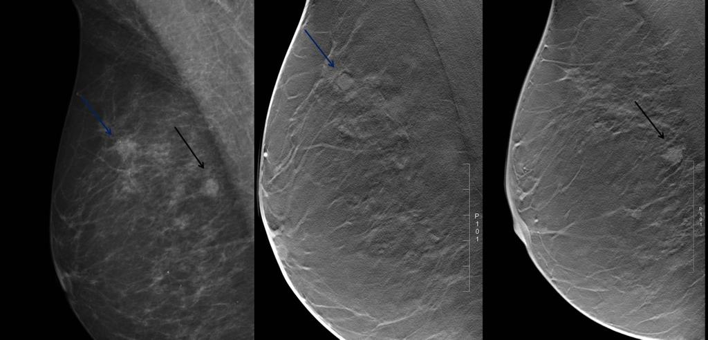 stellate lesion in the central part of the breast (a).