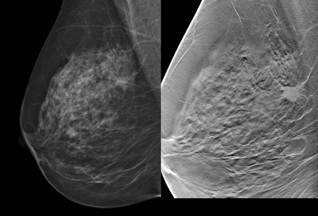 Fig. 0: Fig. 2. Screening mammogram. The 2D image on the left side shows multiple irregular opacities.
