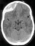 no head trauma visible E: T 38.5 persistent seizures? Coma: midazolam 0.