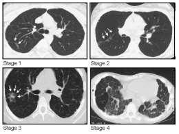Classification of pulmonary fibrosis* Stage 0 fibrosis: Normal CT images, no signs of fibrosis Stage 1 fibrosis: Discrete signs of fibrosis in the periphery of the lungs (subpleurally, <2 cm) or