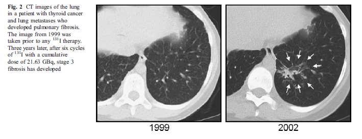 Pulmonary fibrosis Is diagnosed by CT scan Pulmonary function