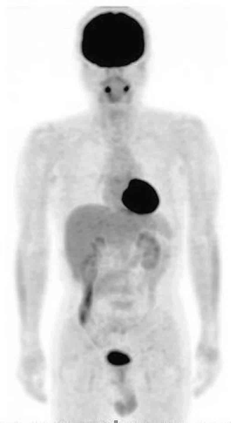 196 H. Otsuka, et al. FDG-PET/CT in clinical oncology side, and breathes freely throughout the examination. The PET/CT scan begins with a topogram that is used to define the axial range of the body.