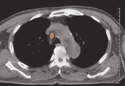 Routine CT examination was unable to distinguish whether the lesion was recurrent or metastatic ; however, FDG- Fig.