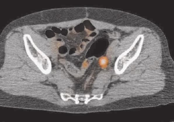 In the PET/CT system, CT data are a) b) Fig. 4 Lymphoma.