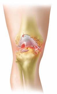 The Knee The knee is a complex joint consisting of bones and healthy cartilage. The end of your femur (thighbone) can be compared to a rocking chair.
