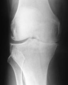This person has severe knee arthritis in the inside (medial) compartment. Steroid injections can help considerably.