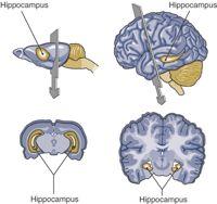 patients tend to be confused, so memories are less clear to begin with Temporal Lobe Anatomy Broad area: medial temporal lobe (MTL) Specifically: hippocampus, a critical area within MTL Hippocampus