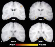 Encoding stage: subjects view photographs while being scanned in fmri Testing stage: after scanning, subjects tested on memory for photographs Results: Photographs that were subsequently remembered