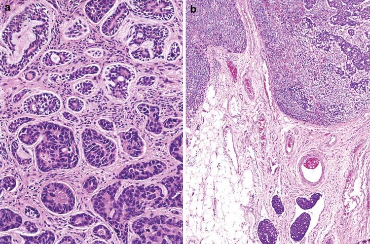 Head and Neck Pathol (2009) 3:69 77 73 Fig. 3 Adenoid cystic carcinoma with high grade transformation.