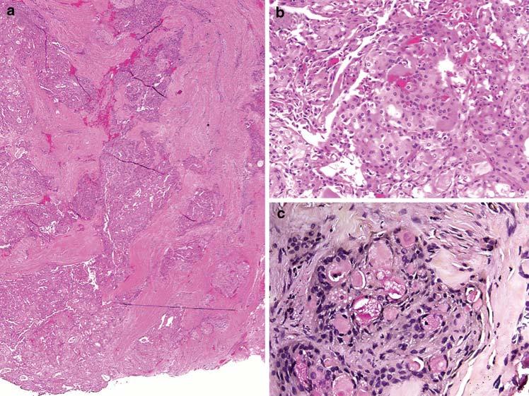 76 Head and Neck Pathol (2009) 3:69 77 Fig. 5 Oncocytic mucoepidermoid carcinoma. a This solid highly infiltrative oncocytic lesion would be classified in some grading schemes as high grade.
