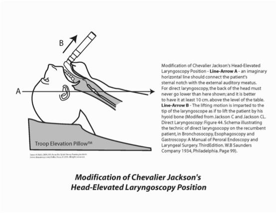 Larynogscopy Head-Elevated Larynogscopy