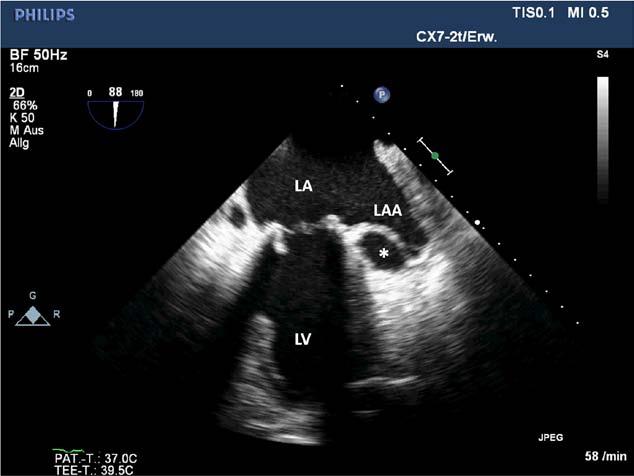 See corresponding Movie I in the online-only Data Supplement. Ao indicates ascending aorta; LA, left atrium; LV, left ventricle; and RV, right ventricle. Figure 3.