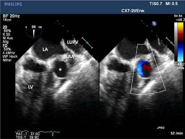 A hypoechogenic space located between the anterior wall of the left ventricle and the left atrial appendage can be seen (asterisk).