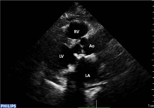 Two-dimensional transthoracic echocardiographic examination at admission (parasternal long-axis view, diastole). The mitral valve prosthesis can be seen.
