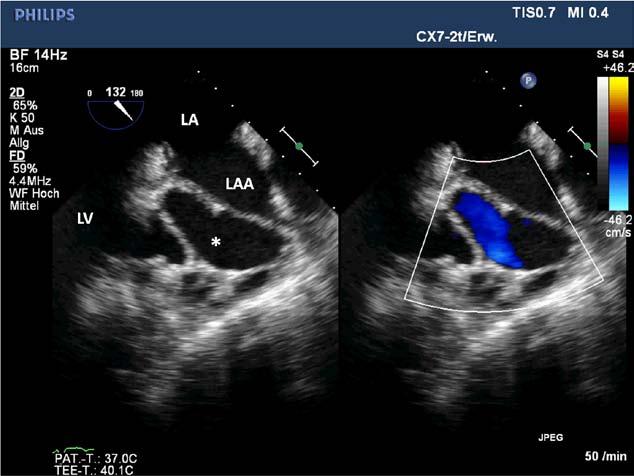 See corresponding Movie V in the online-only Data Supplement. LA indicates left atrium; LAA, left atrial appendage; and LV, left ventricle. Figure 7.