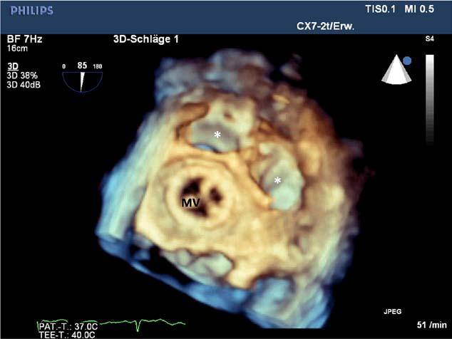 See corresponding Movie VII in the online-only Data Supplement. MV indicates mitral valve prosthesis. Figure 6.