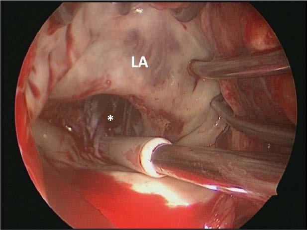 LA indicates left atrium; LAA, left atrial appendage; and LV, left ventricle.. Figure 10.