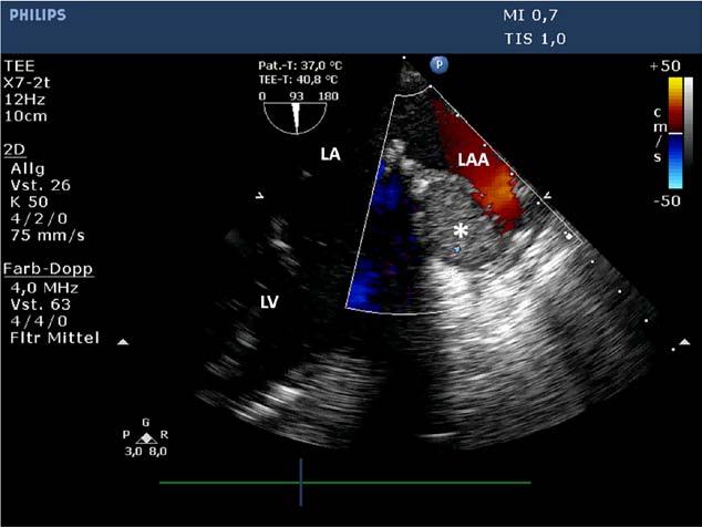 Two-dimensional transthoracic echocardiographic examination at discharge (parasternal long-axis view, diastole). The mitral valve prosthesis can be seen.