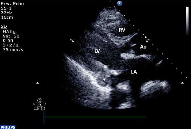 Ao indicates ascending aorta; LA, left atrium; LV, left ventricle; and RV, right ventricle. Figure 14.