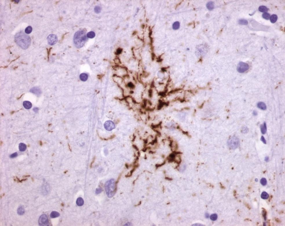Frontotemporal Lobar Degeneration (FTLD) Tufted Astrocytes (phospho-tau) Neuronal Inclusions and Threads (phospho-tau