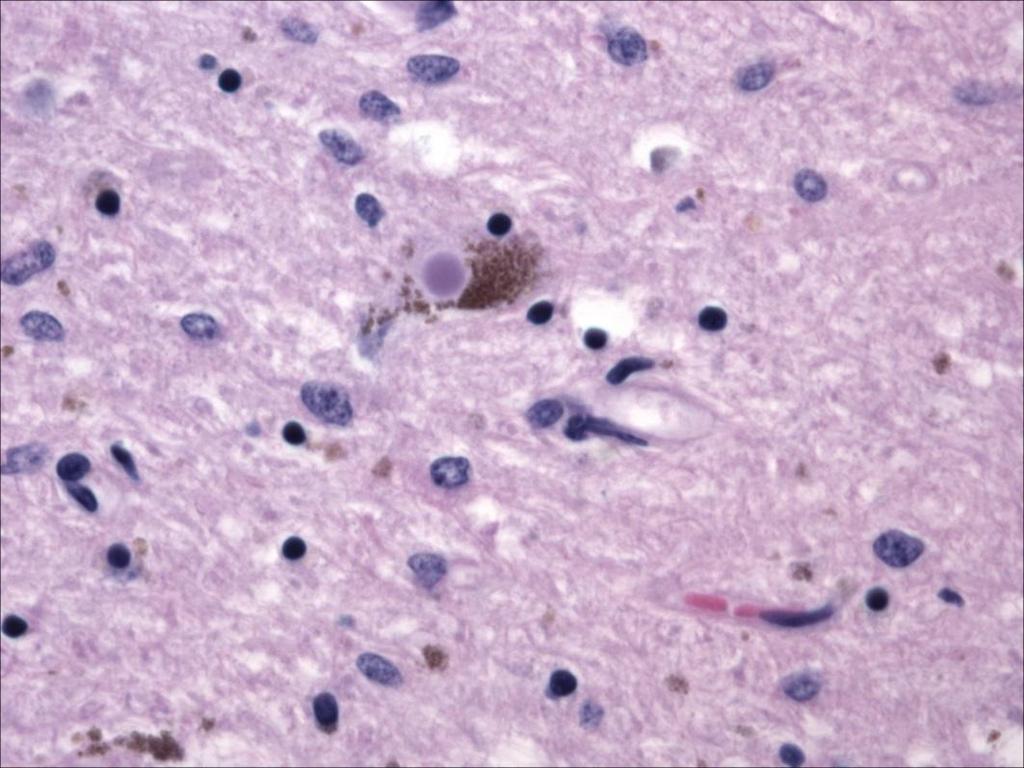 Diffuse Lewy Body Disease Cortex, α-synuclein immunostain Substantia nigra