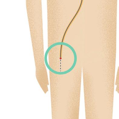 The WATCHMAN Procedure The WATCHMAN Implant is about the size of a quarter, and it doesn