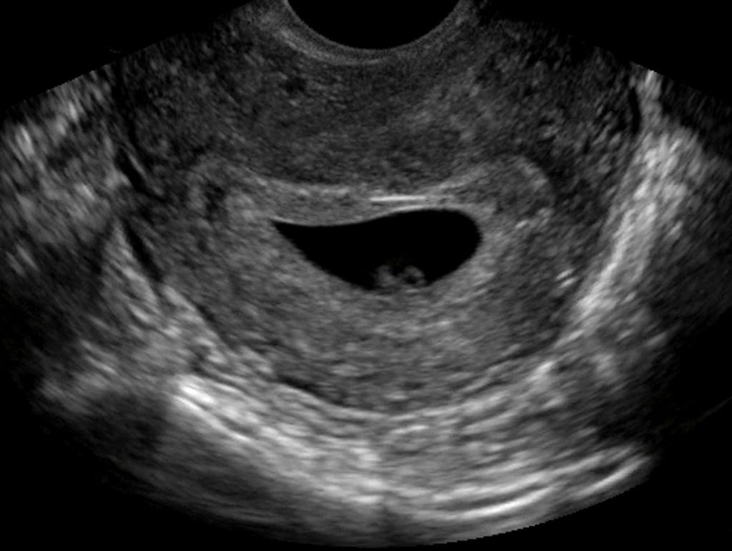 Minimum O Transvaginal U/S Imaging Guidelines: 1. Uterus in longitudinal...fig 2. Uterus in transverse HI.