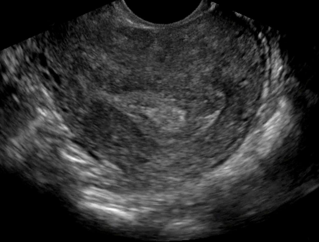 shouldn t be doing a transvaginal...just saying)...fig F 8. Fetal heart rate (in M-mode).