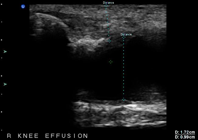 Minimum U/S-Guided rthrocentesis Imaging Guidelines: 1. ONE image of the joint effusion, preferably with caliper measurements (not necessary to do orthogonal planes).