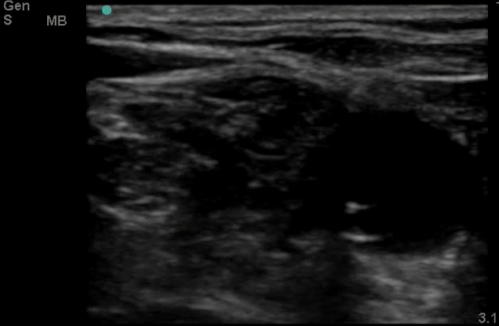 Minimum U/S-Guided Central Line Imaging Guidelines: 1. ONE image of the catheter or needle in the vessel, either in transverse or longitudinal.