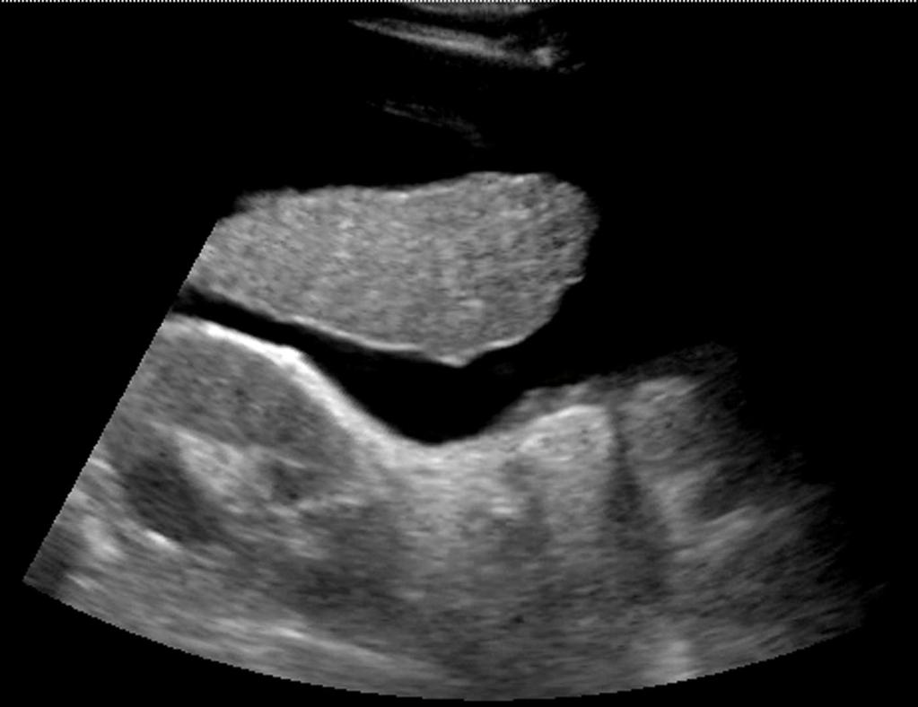 Minimum U/S-Guided Paracentesis Imaging Guidelines: 1. ONE image of the ascites (not necessary to do orthogonal planes).